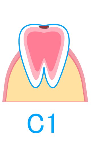 C1：エナメル質のむし歯