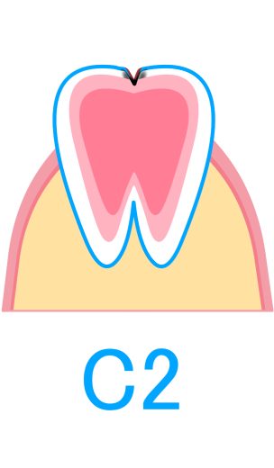 C2：象牙質のむし歯