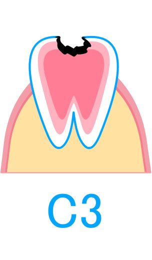 C3：神経にまで進行したむし歯