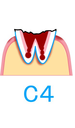 C4：歯根まで進行したむし歯