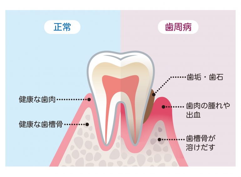 知らない間に進行する歯周病