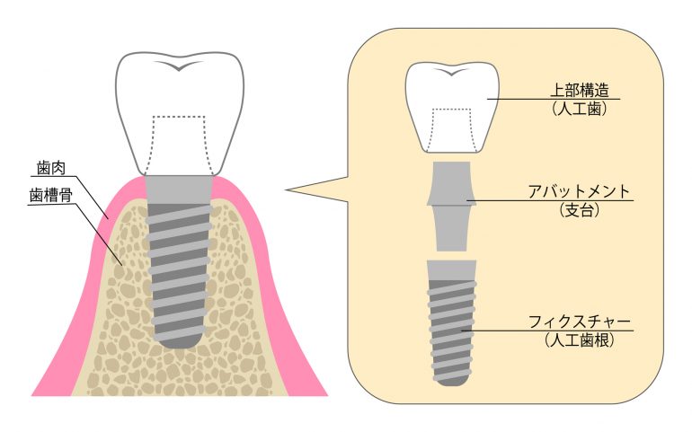 インプラント治療とは