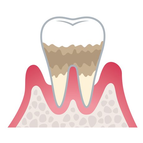 中度歯周病（歯周炎）