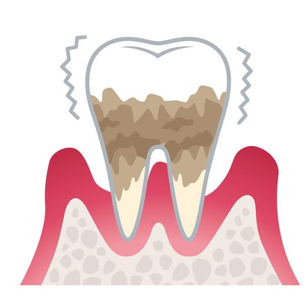 重度歯周病（歯周炎）