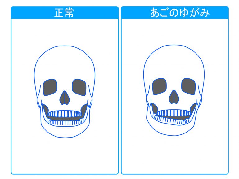 お顔の変形